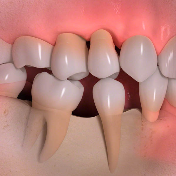 Jaw bone deterioration 02