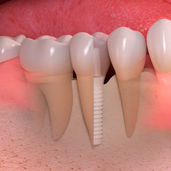 Side cut of ceramic implant 02